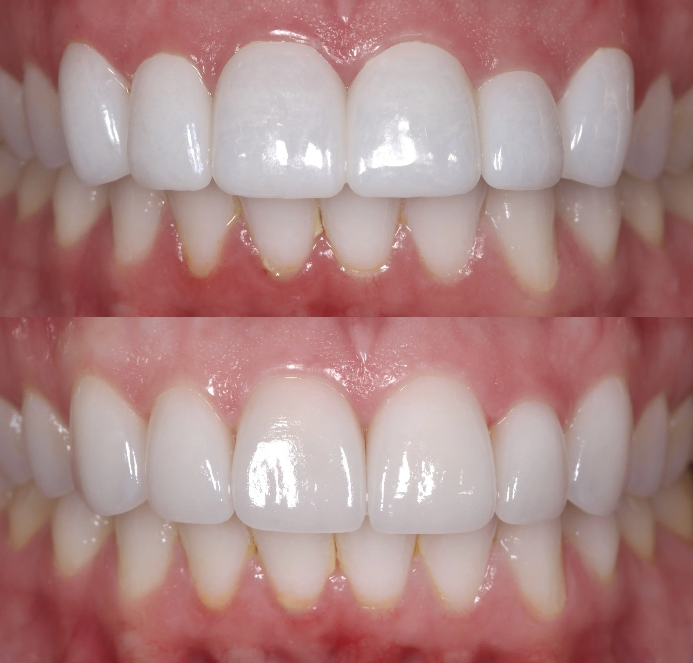 6 Veneers in Shade 0.5M1
