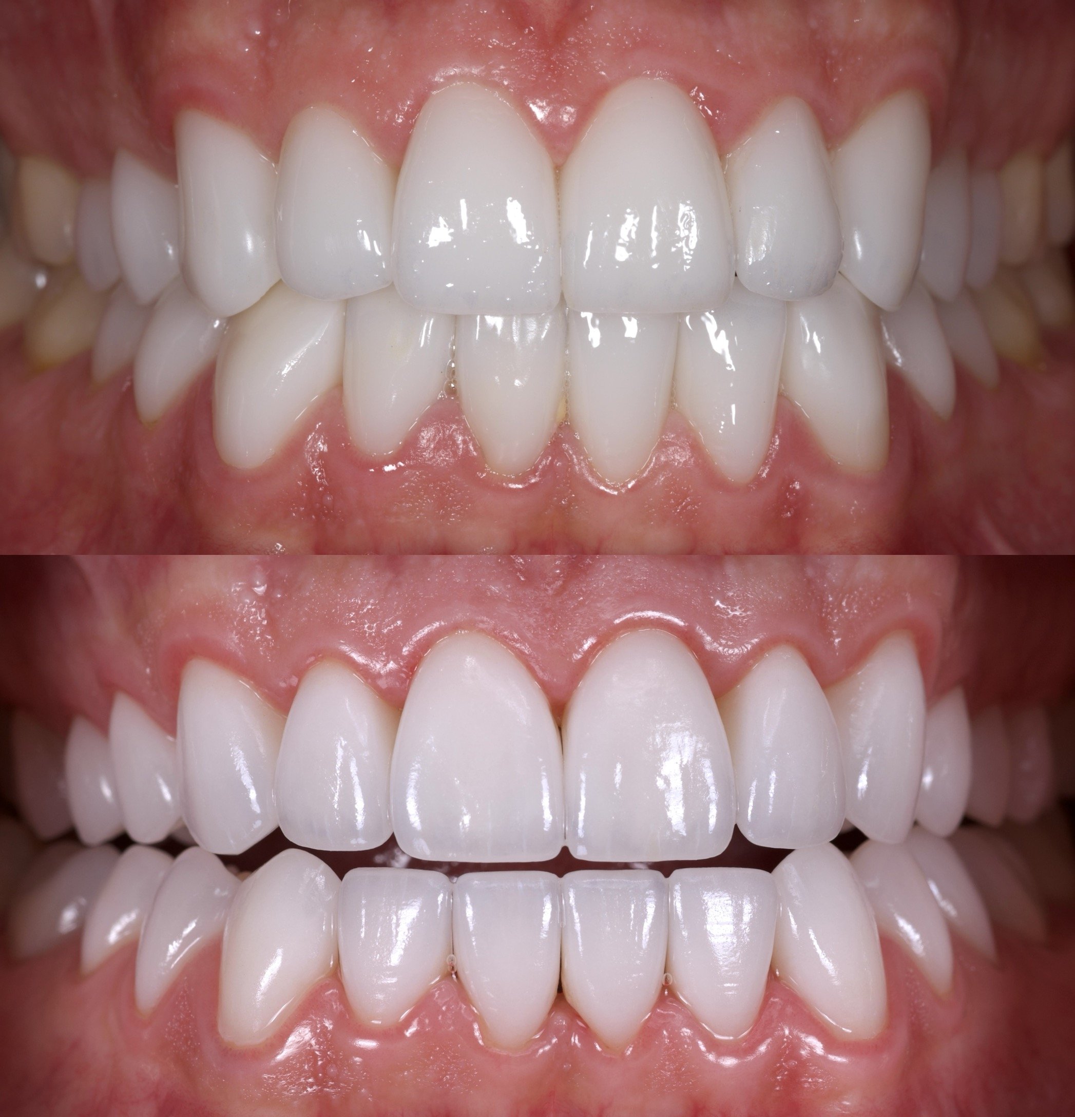 Veneers in Newport Beach by Jeremy Heldt, DDS