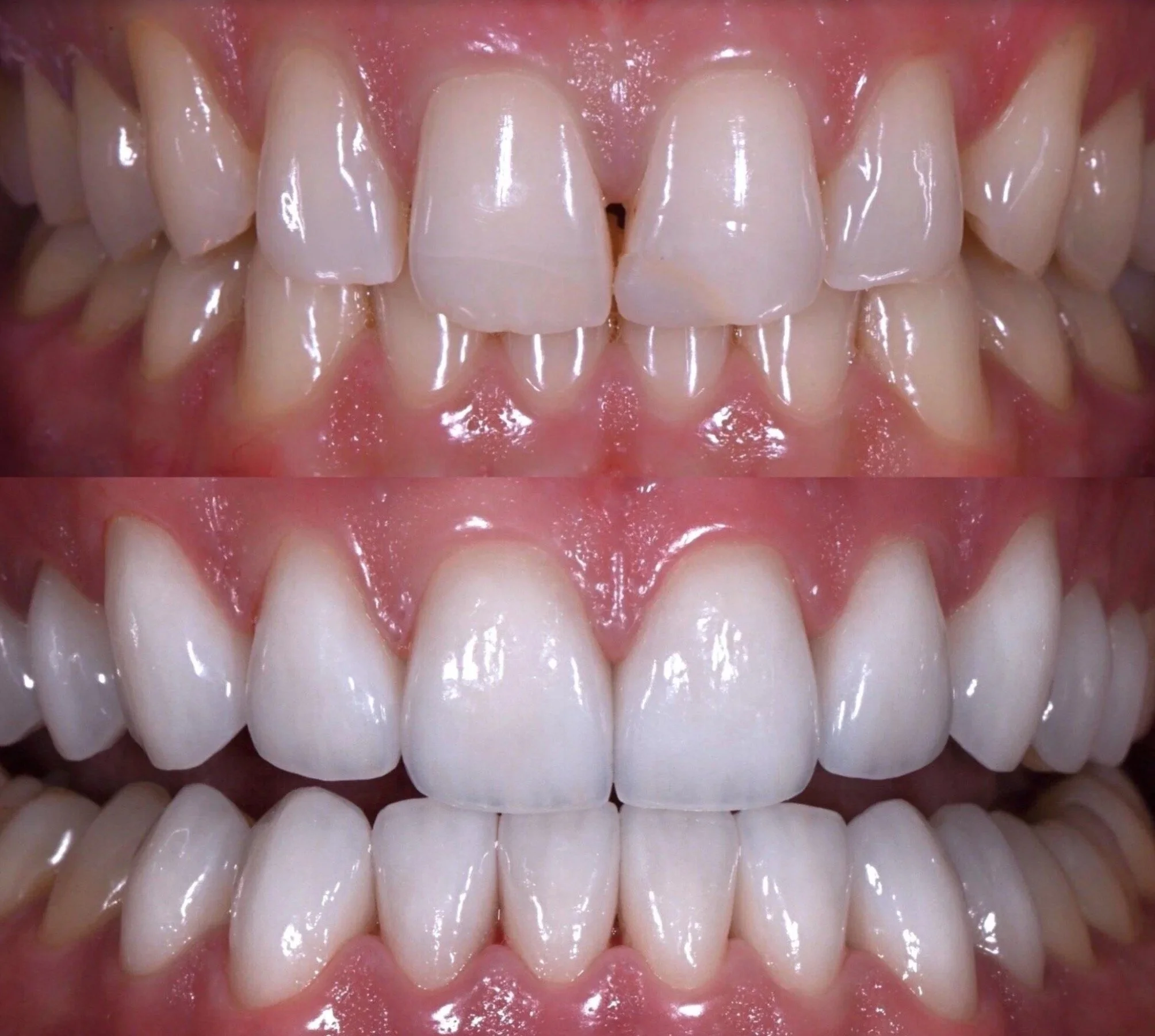 Veneers in Newport Beach by Jeremy Heldt, DDS