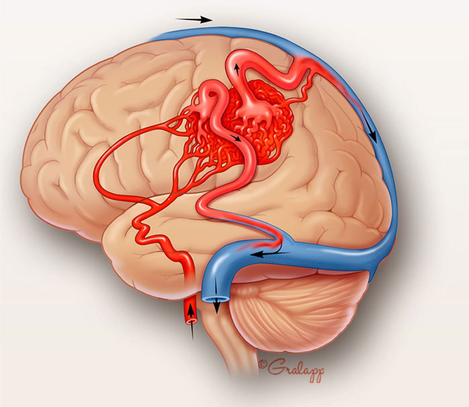 Венозная дисциркуляция головного мозга