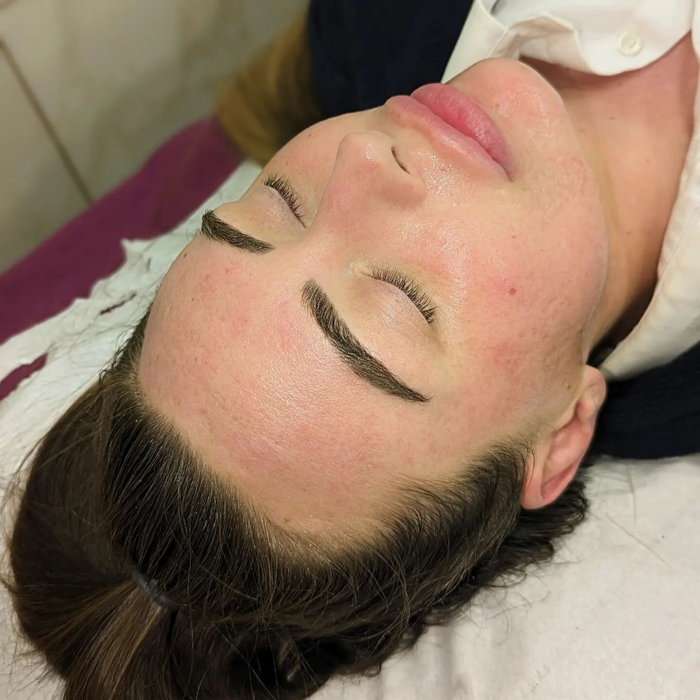 DERMAPLANING ☀️ Results Straight After Treatment With Erin.

Swipe To See What Was Removed During Treatment.

What Are The Benefits Of Dermaplaning?
☀️Provides Deeper Product Penetration.
☀️Removes Soft Facial Hair That Traps Dirt &amp; Oils.
☀️Promo