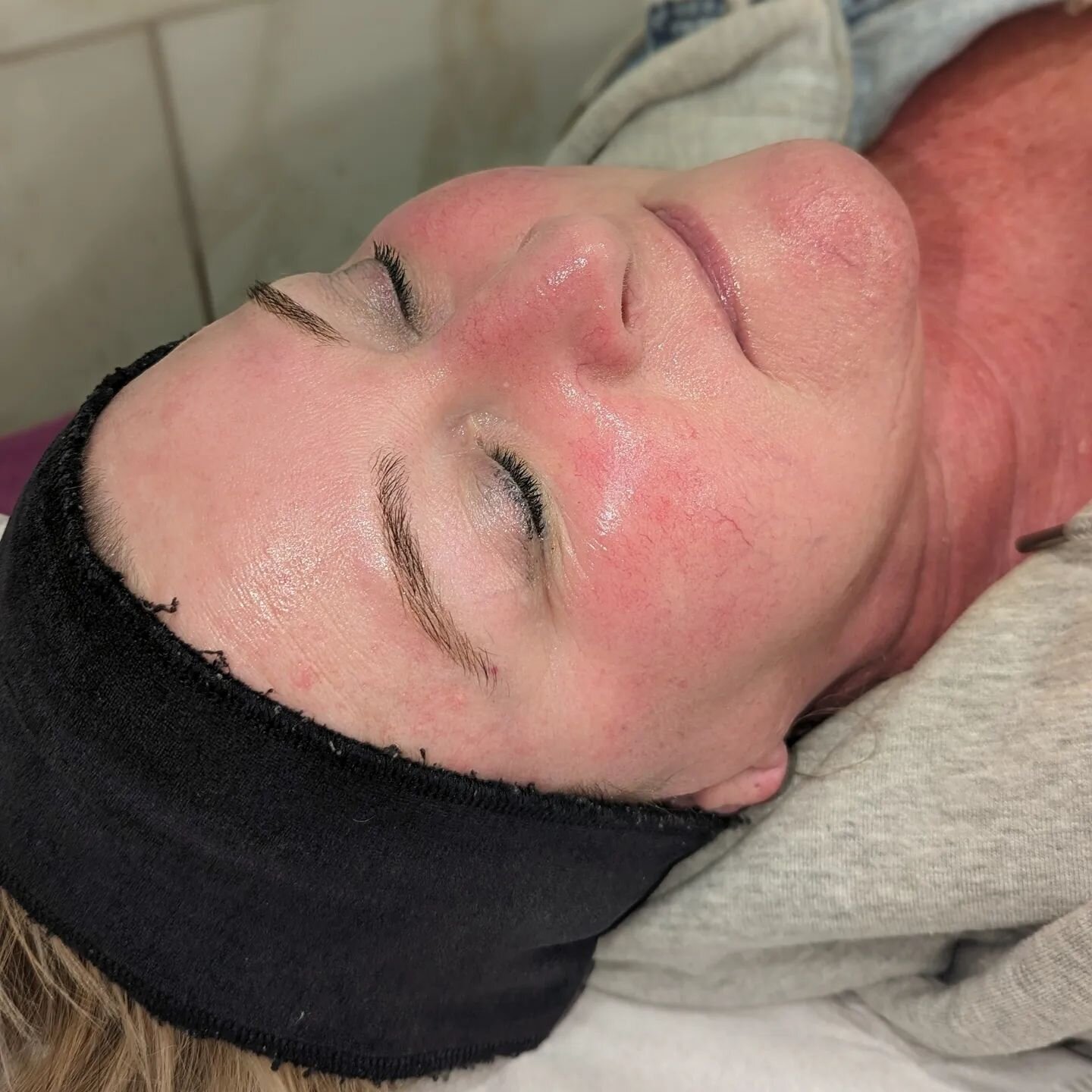 DERMAPLANING ☀️ Results Straight After Treatment With Erin.

What Are The Benefits Of Dermaplaning?
☀️Provides Deeper Product Penetration.
☀️Removes Soft Facial Hair That Traps Dirt &amp; Oils.
☀️Promotes Smoother Skin.
☀️Safe Procedure For Removing 