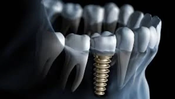 implant model.jpg