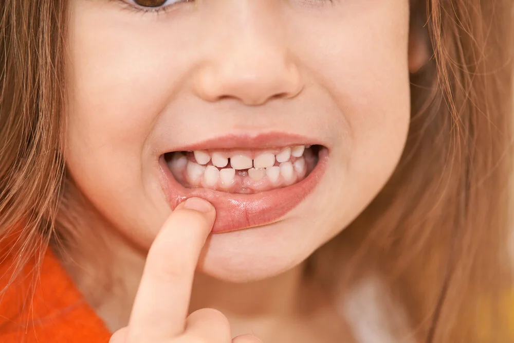 How to Correct a Small Teeth?