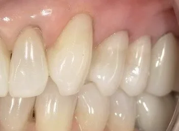 After treatment showing natural-looking tooth-colored fillings near the gumline