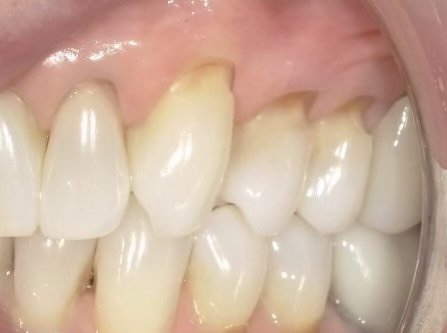 Before treatment showing the gumline area requiring tooth-colored fillings