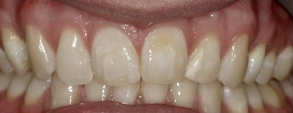 Before non-invasive white spot treatment