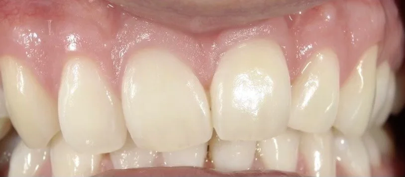 After non-invasive white spot treatment completed in 45 minutes