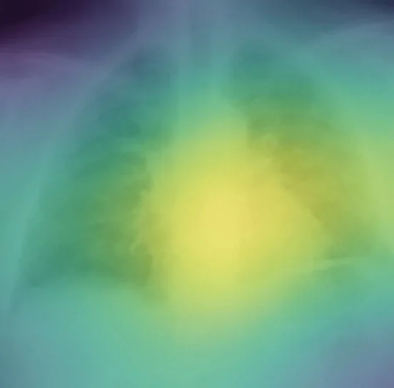 Deep Learning predicts mortality from x-rays