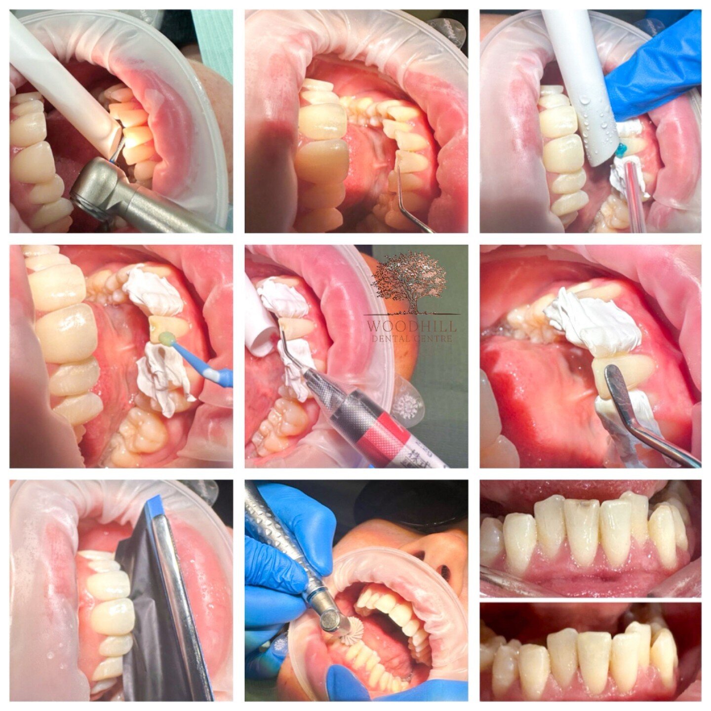 Transforming the appearance of a patient's smile can have a significant impact on their self-confidence. In the case of a cracked front tooth that had started to decay a simple composite filling was the chosen treatment option. Here are the general s