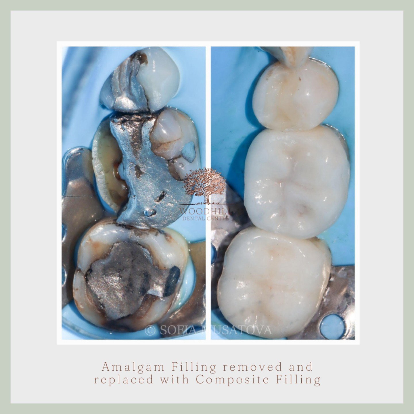 In this patients dental case, we demonstrate the removal of old fillings and decay, followed by the restoration of teeth using emax full porcelain crowns. The patient's worn and decayed teeth were carefully treated and prepared before the emax restor