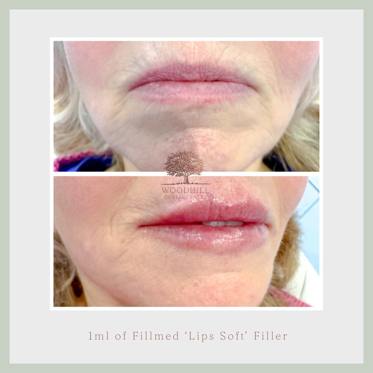 A beautiful and natural lip transformation for this lovely patient! 💋✨