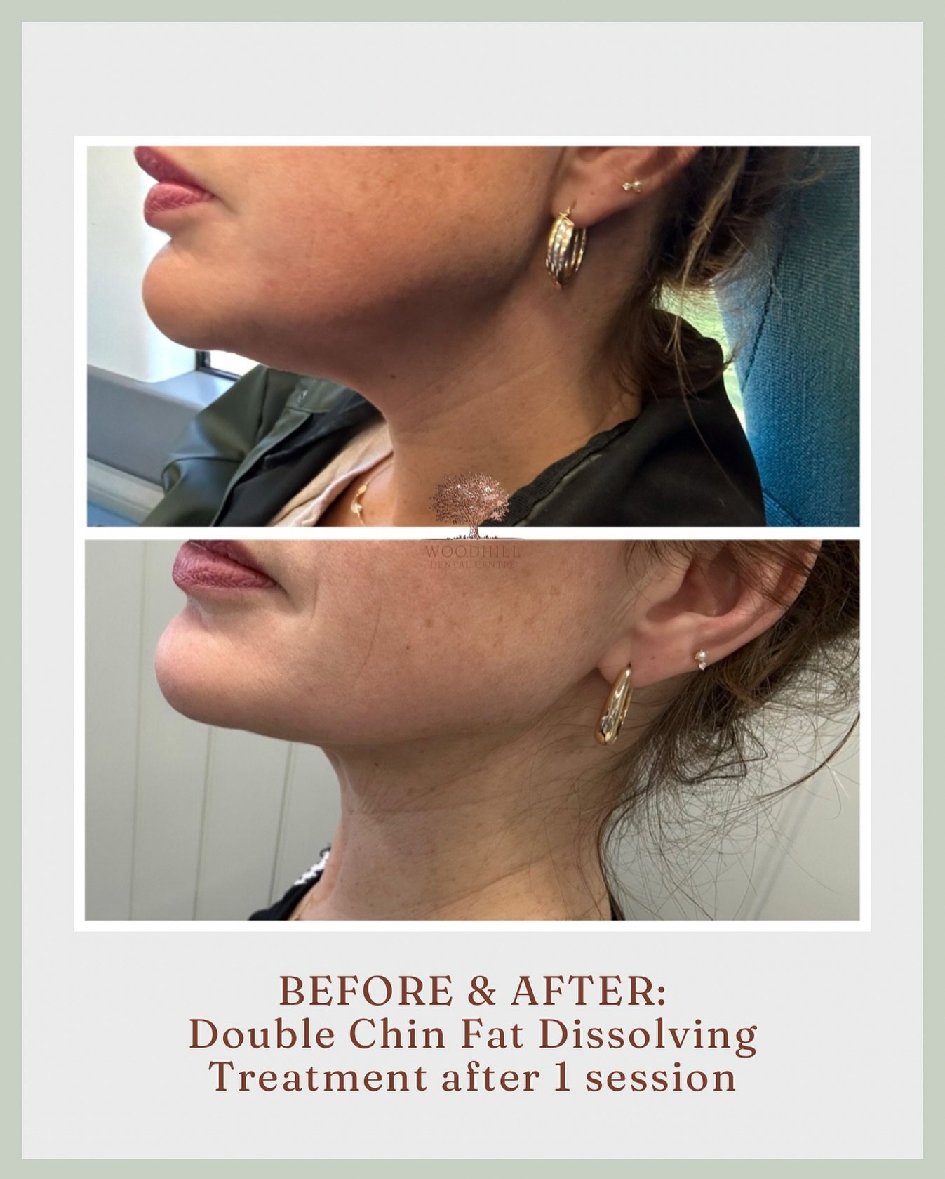 Say Goodbye to Stubborn Fat - No Surgery Needed 💪🏼

Tried the gym? Watched your diet? But some areas just won&rsquo;t budge?

Fat dissolving injections might be the solution you&rsquo;ve been waiting for.
This non-surgical treatment targets those s