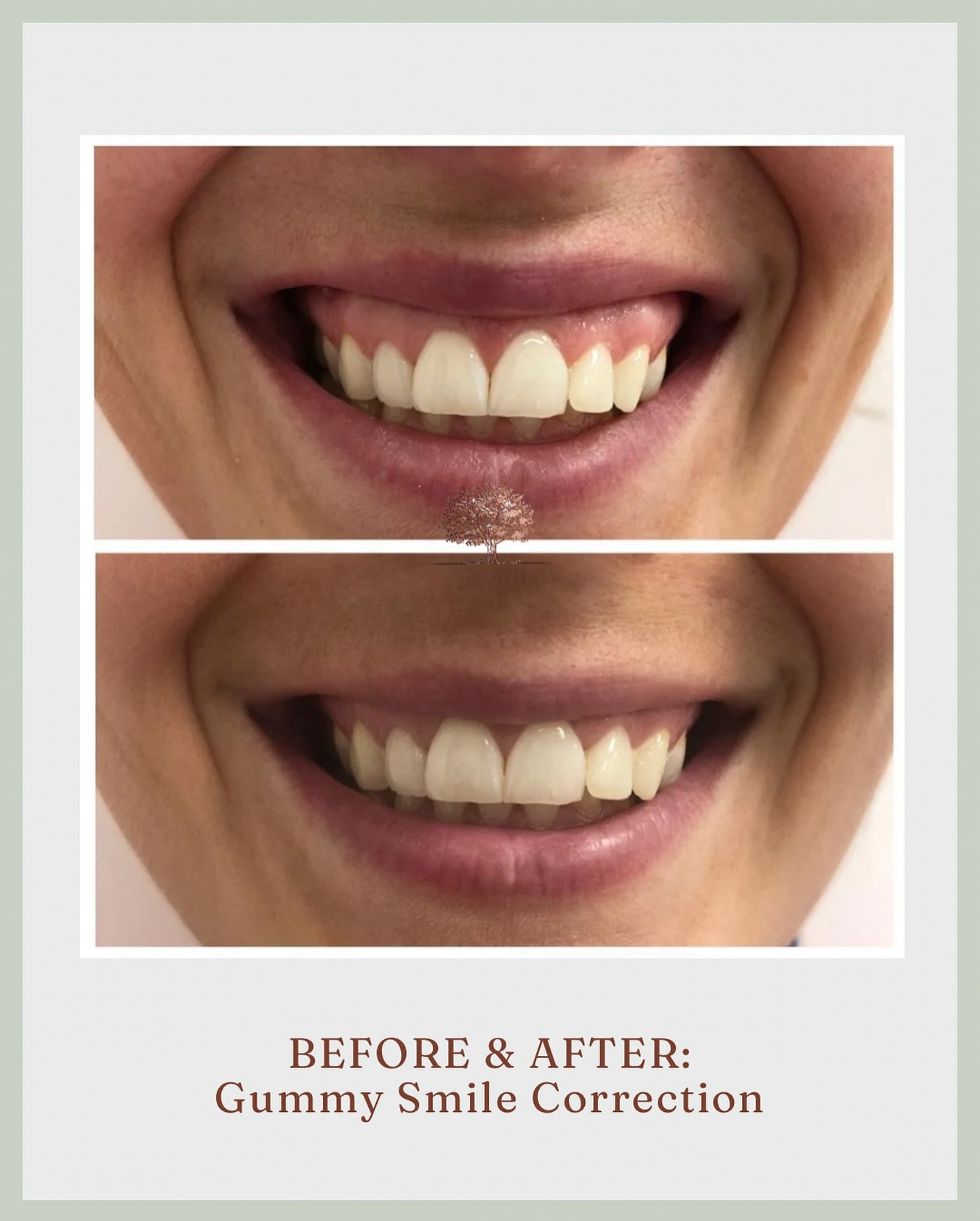 A beautiful smile is all about balance &mdash; and if your upper lip lifts a little higher than you&rsquo;d like when you smile, botox can help.

By gently relaxing the muscles that cause the upper lip to rise too much, we can create a more even, har