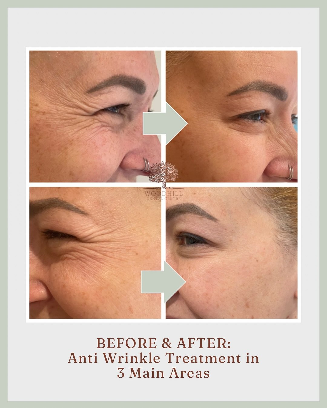 ✨ Say goodbye to those smile lines around your eyes &mdash; and hello to a refreshed, natural look! ✨

This patient had anti-wrinkle (botox) injections in 3 of the main areas - crow&rsquo;s feet, forehead and frown lines to soften those fine lines ca