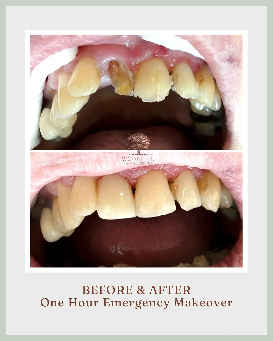 One-Hour Emergency Makeover ✨

Our patient came in as an emergency with broken front teeth. One tooth was borderline un-restorable, so we agreed on a short-term fix &mdash; something that might not last forever, but could restore function and confide