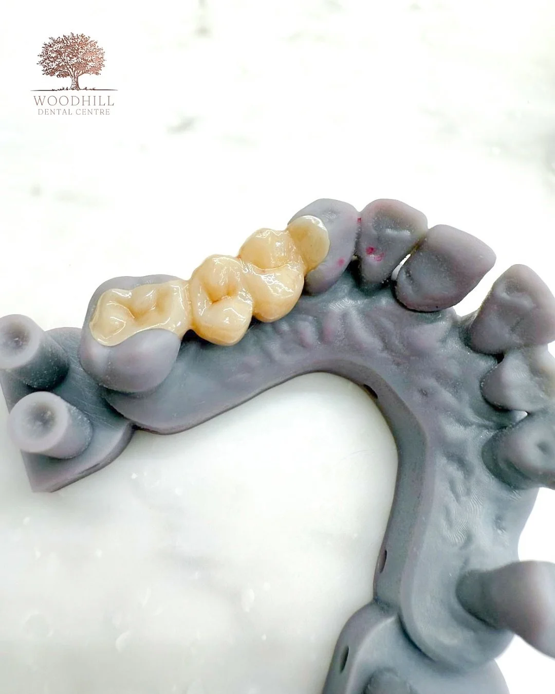 Our patient had a two-tooth gap but wanted to avoid implants or a traditional bridge that would remove healthy tooth tissue. With a history of gum disease (now well controlled), preserving the surrounding teeth was especially important. By removing o