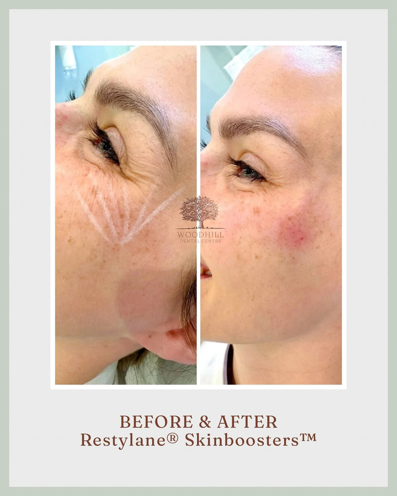 Smooth, Natural, Refreshed ✨

 This before-and-after shows the subtle magic of Restylane Skin Boosters around the crows&rsquo; feet area. Unlike anti-wrinkle treatments like Botox, skin boosters target the super fine lines that are too delicate to tr