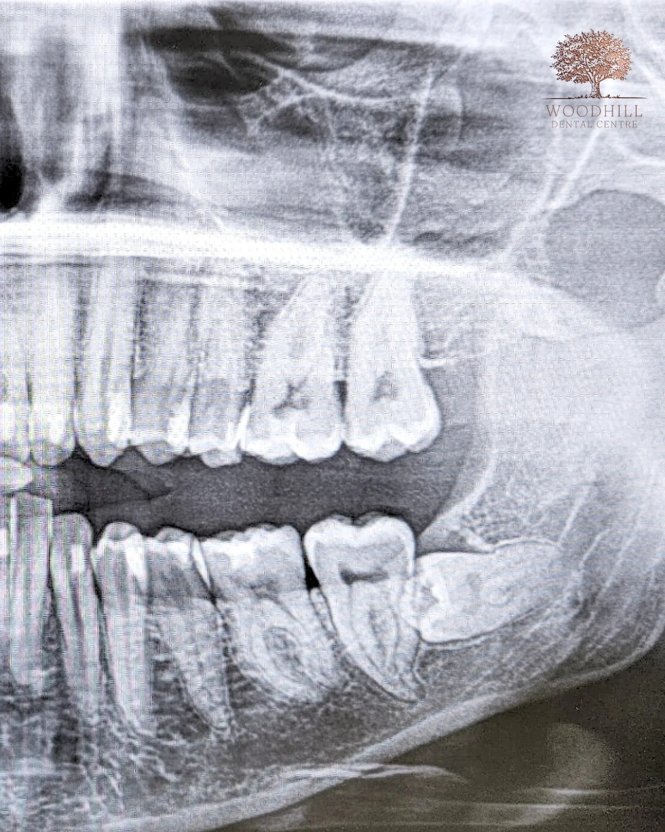 Wisdom Tooth Worries? 🦷

 Soreness, swelling, or repeated infections around your wisdom teeth can be a sign they&rsquo;re struggling to come through properly. Left untreated, they can cause ongoing pain, periodontal issues, decay or even worse damag