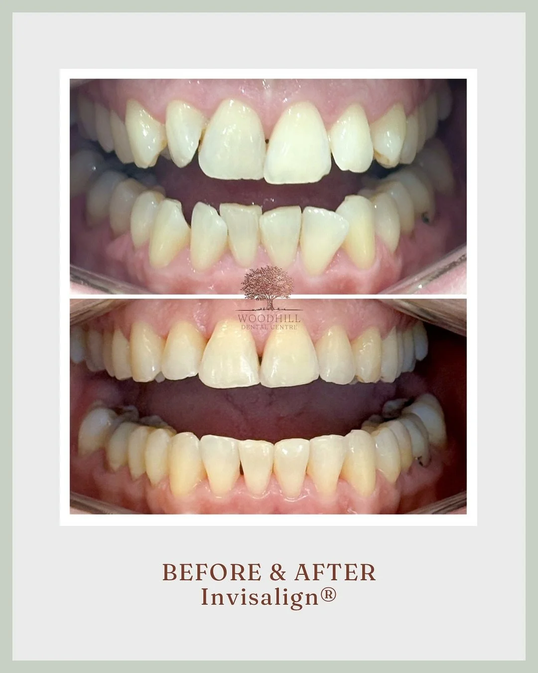In just 6 months, this patient achieved a beautifully straight smile 🦷💫

Invisalign&reg; uses clear, removable aligners to gradually straighten teeth! Simple, discreet, and effective!

#InvisalignJourney #SmileTransformation #StraightTeeth #ClearAl