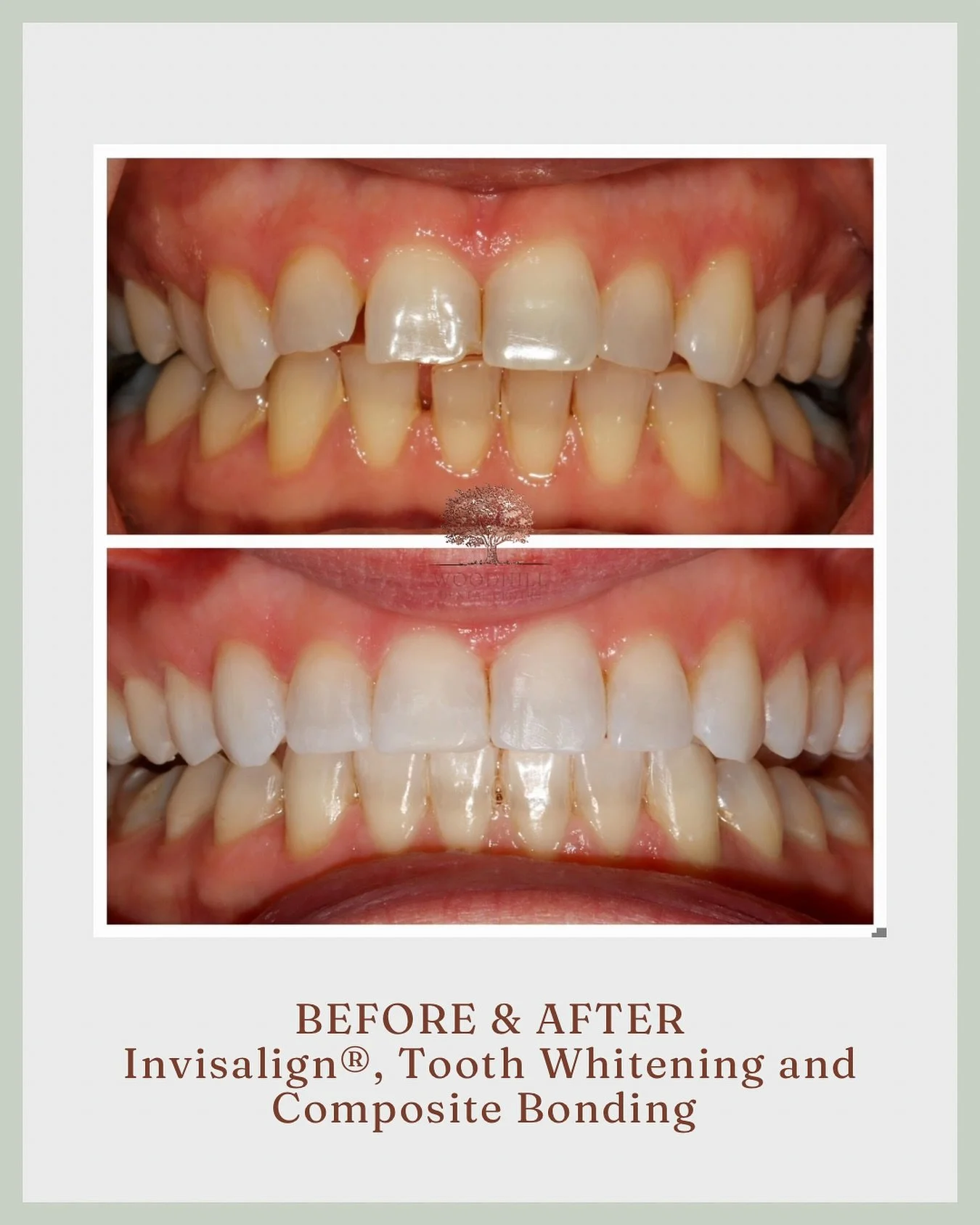 This before and after shows just how much of a difference the right combination of treatments can make!

For this transformation, we used:
🦷 Invisalign&reg; to straighten and align
🤍 Whitening to brighten
✨ Composite bonding to perfect the shape an