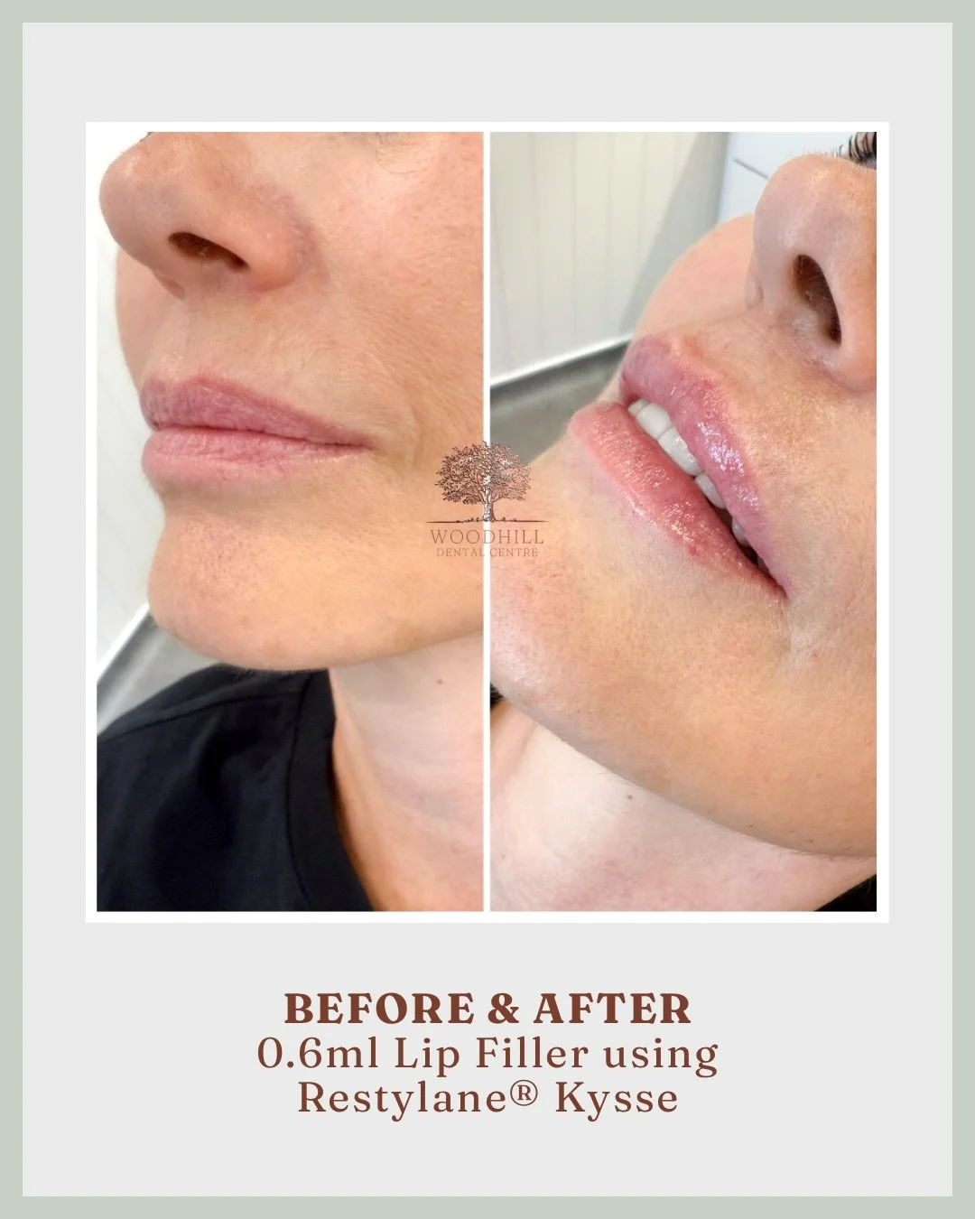 A little 0.6ml Restylane&reg; Kysse goes a long way! 💋

 Enhancing the natural shape with a touch more volume, and giving a gorgeous hydrated finish!

#ReystylaneKysse #Reystylane #LipFiller #LipVolume #NaturalEnhancement #Aesthetics #MayfieldAesthe