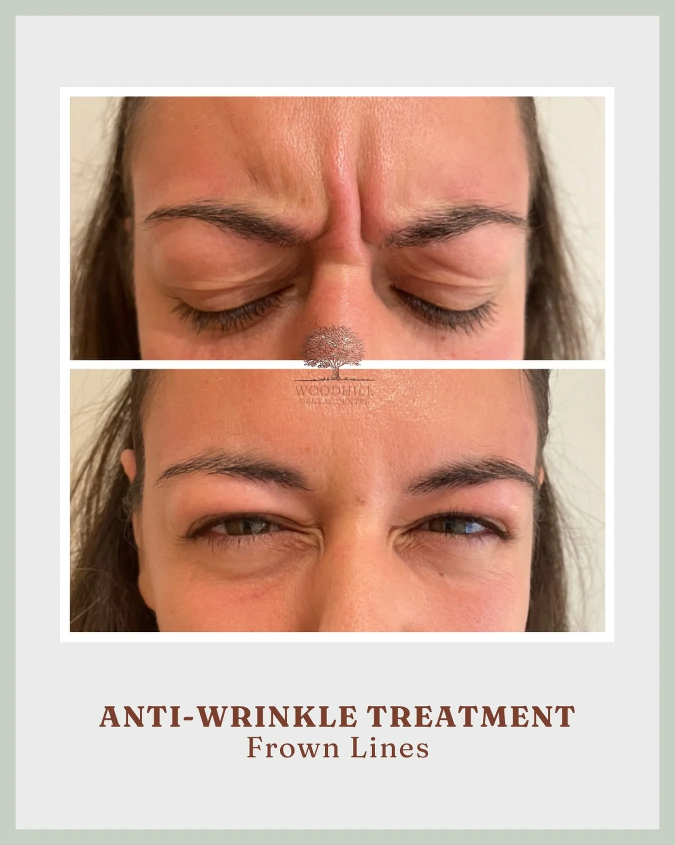 ✨ Before &amp; After - Frown Lines ✨

A subtle refresh for the frown area, designed to soften lines while keeping natural expression. The aim here isn&rsquo;t to freeze the face, but to gently relax the muscles that cause frown lines to deepen over t