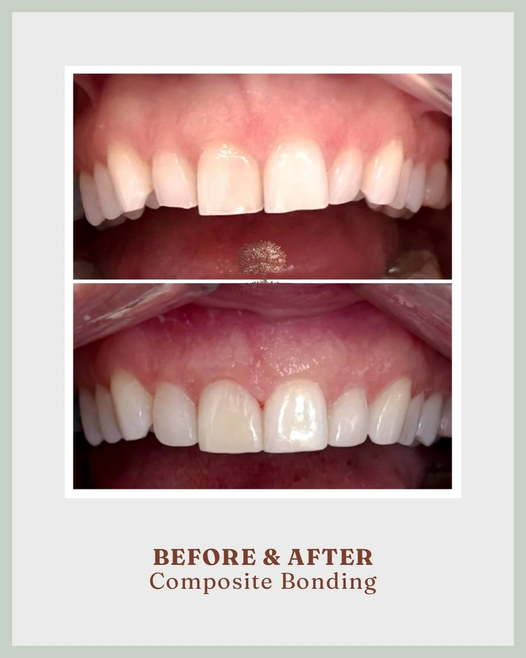 This case is a great example of how teeth can be well aligned but still feel slightly unbalanced. 

Here, the issue wasn&rsquo;t position, but a difference in size and shape. The lateral incisors were smaller and sat a little further back in the arch