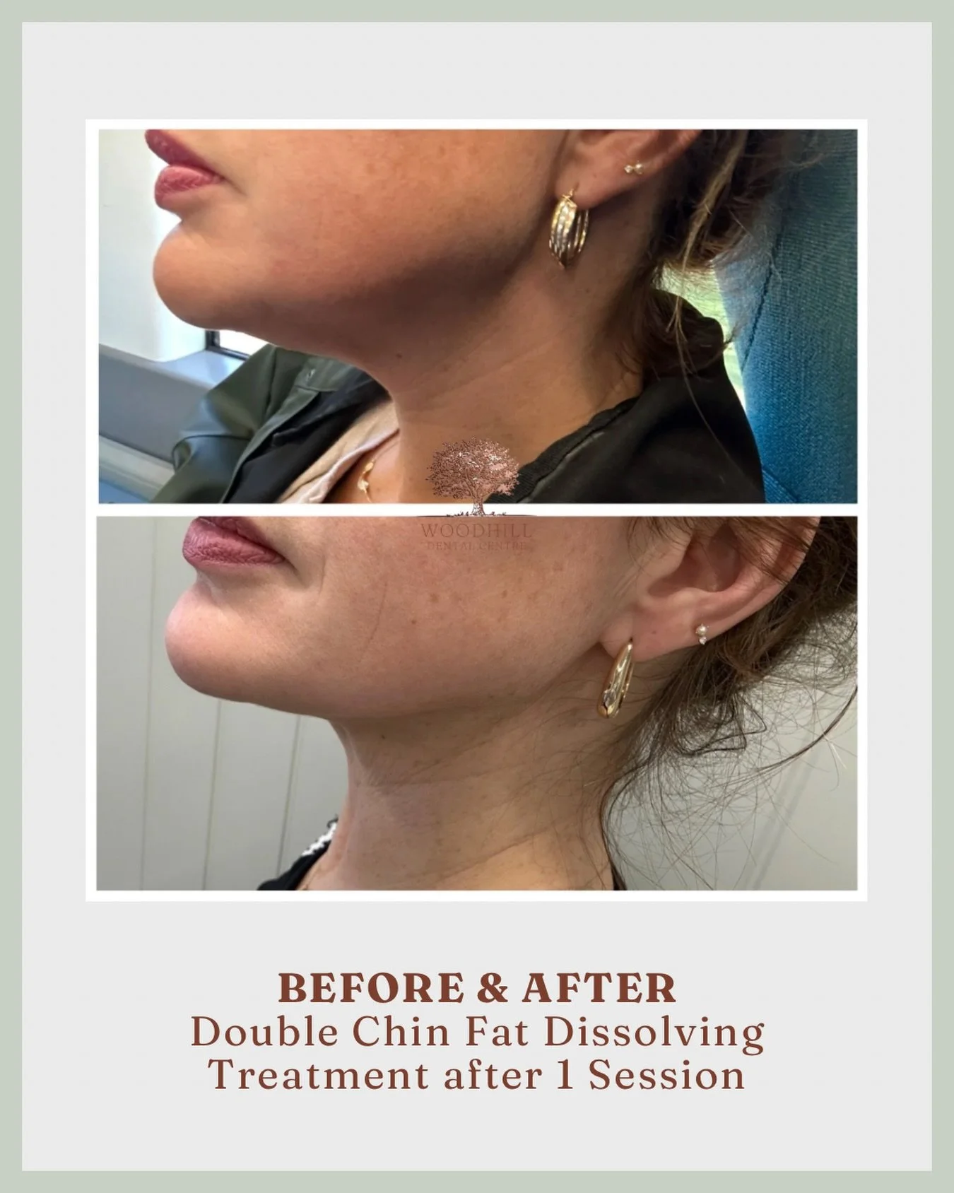 These results shown are 4 weeks post treatment.

Fat dissolving injections target stubborn pockets of fat that can be resistant to diet and exercise. In the weeks following treatment, the body gradually breaks down and naturally processes the treated