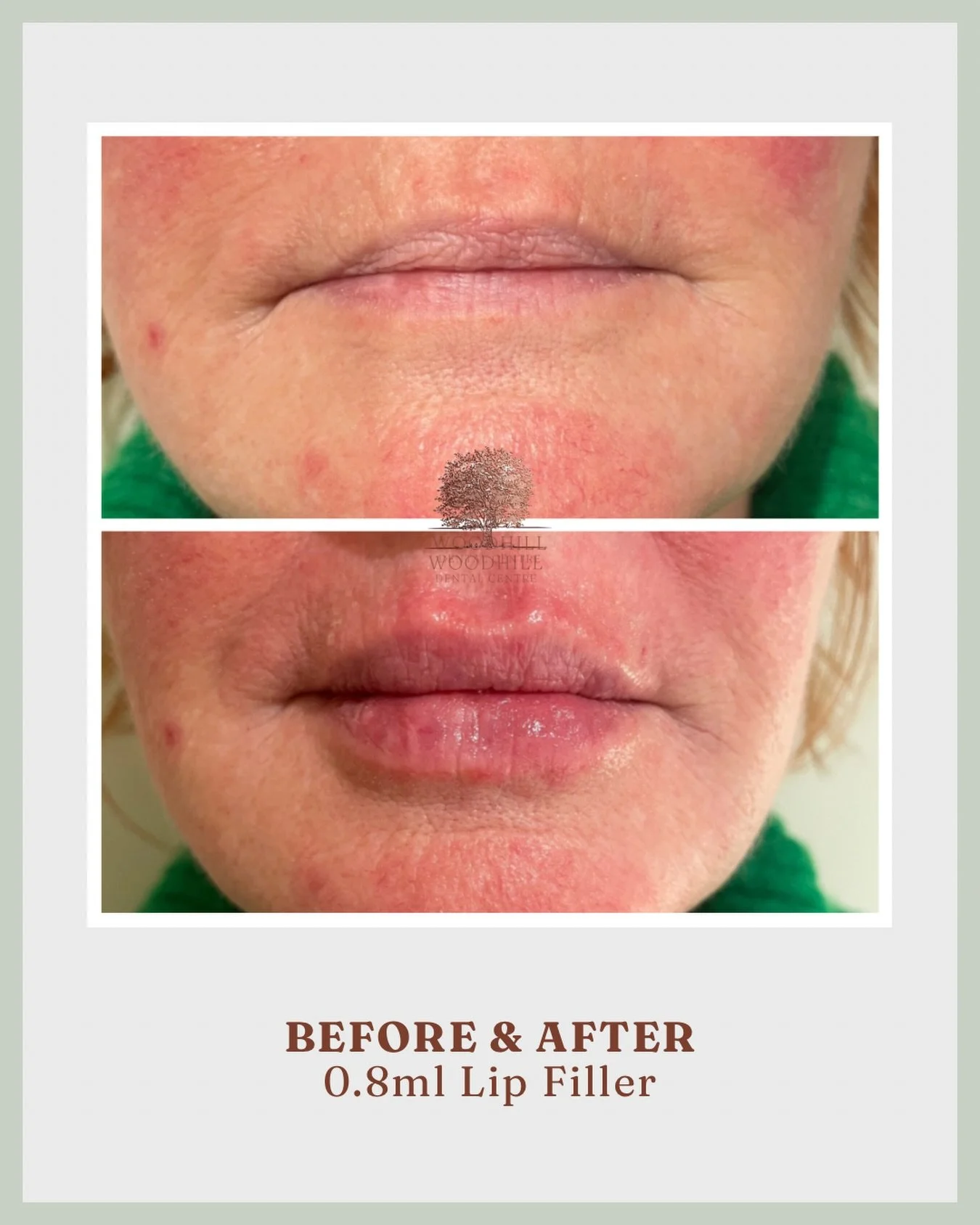 With just 0.8ml of lip filler, we&rsquo;ve added definition and subtle plumpness, enhancing the lips while keeping them looking completely natural 💋

#LipFiller #NaturalResults #PlumpLips #FacialAesthetics #SubtleEnhancement