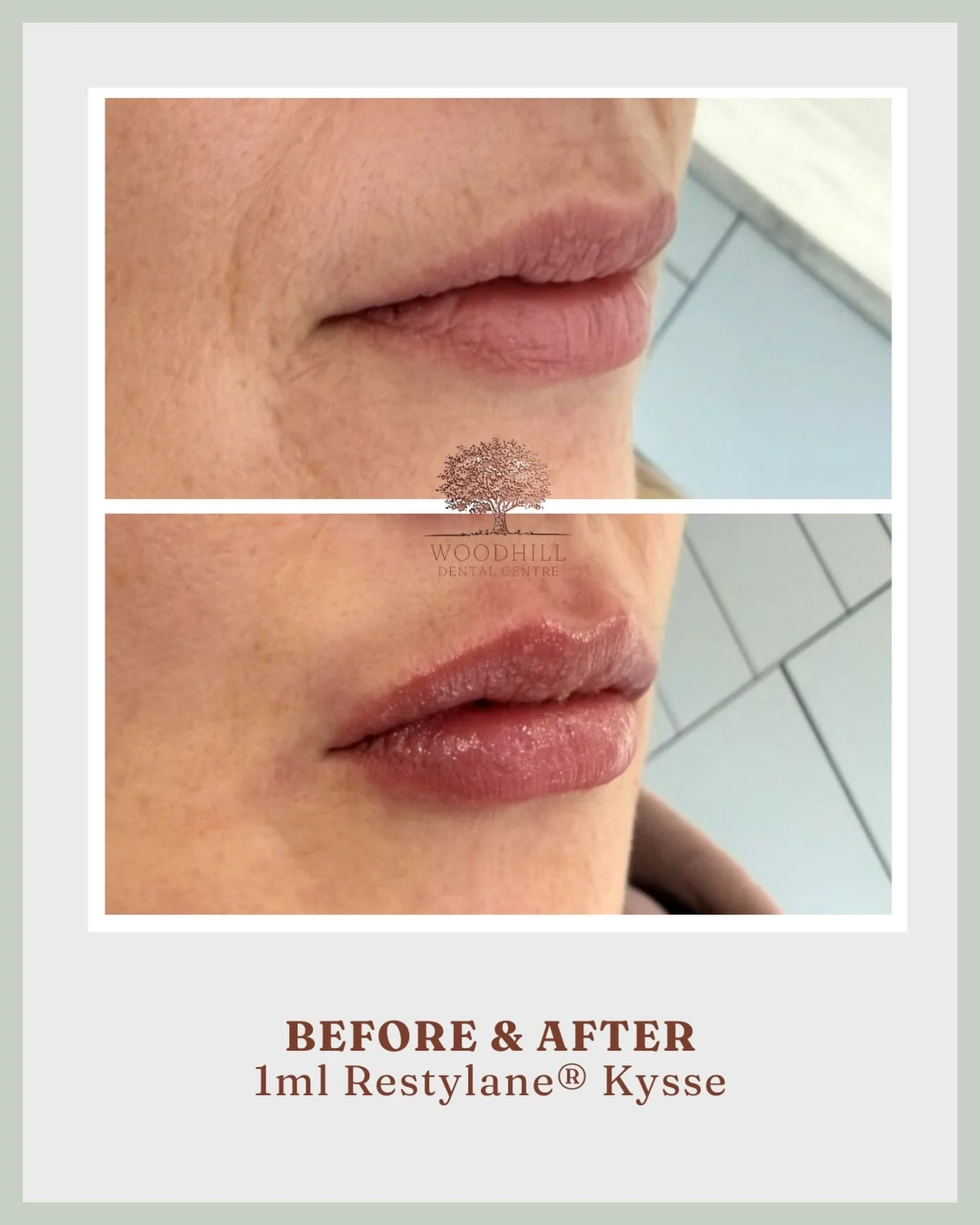 This patient was self conscious about the natural &ldquo;M-shape&rdquo; of the upper lip, which created small gaps where the teeth could be seen even when the mouth was closed.

Using 1ml of Restylane&reg; Kysse, filler was carefully placed to soften