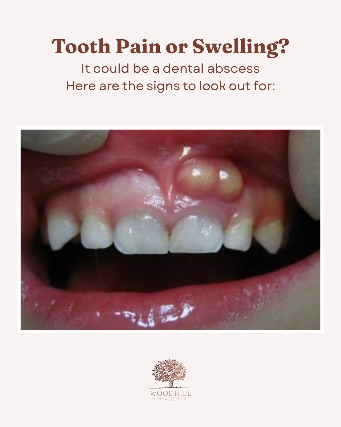 A dental abscess is a painful infection that requires prompt treatment. Signs can include severe toothache, swelling of the gums or face, sensitivity when biting, a bad taste in the mouth, or pus around the tooth.

If you notice any of these symptoms