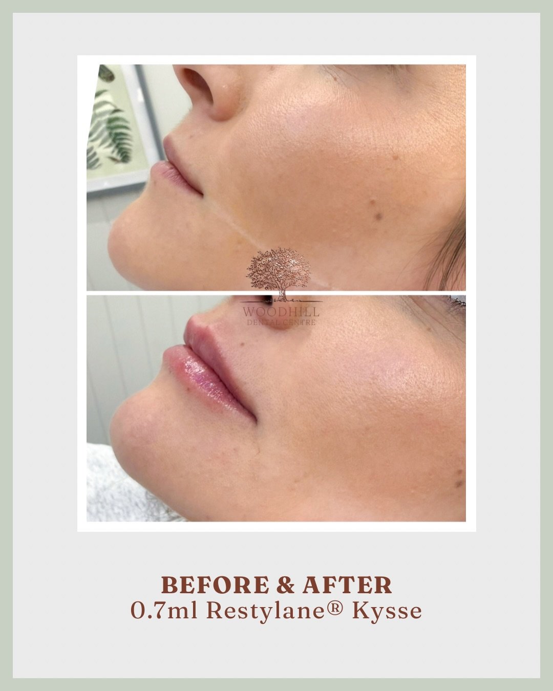 Beautiful results for our bride to be using 0.7ml of Restylane&reg; Kysse. This treatment enhances the lips with a focus on natural volume, shape, and definition while maintaining softness and movement 💋

#LipFiller #RestylaneKysse #FacialAesthetics