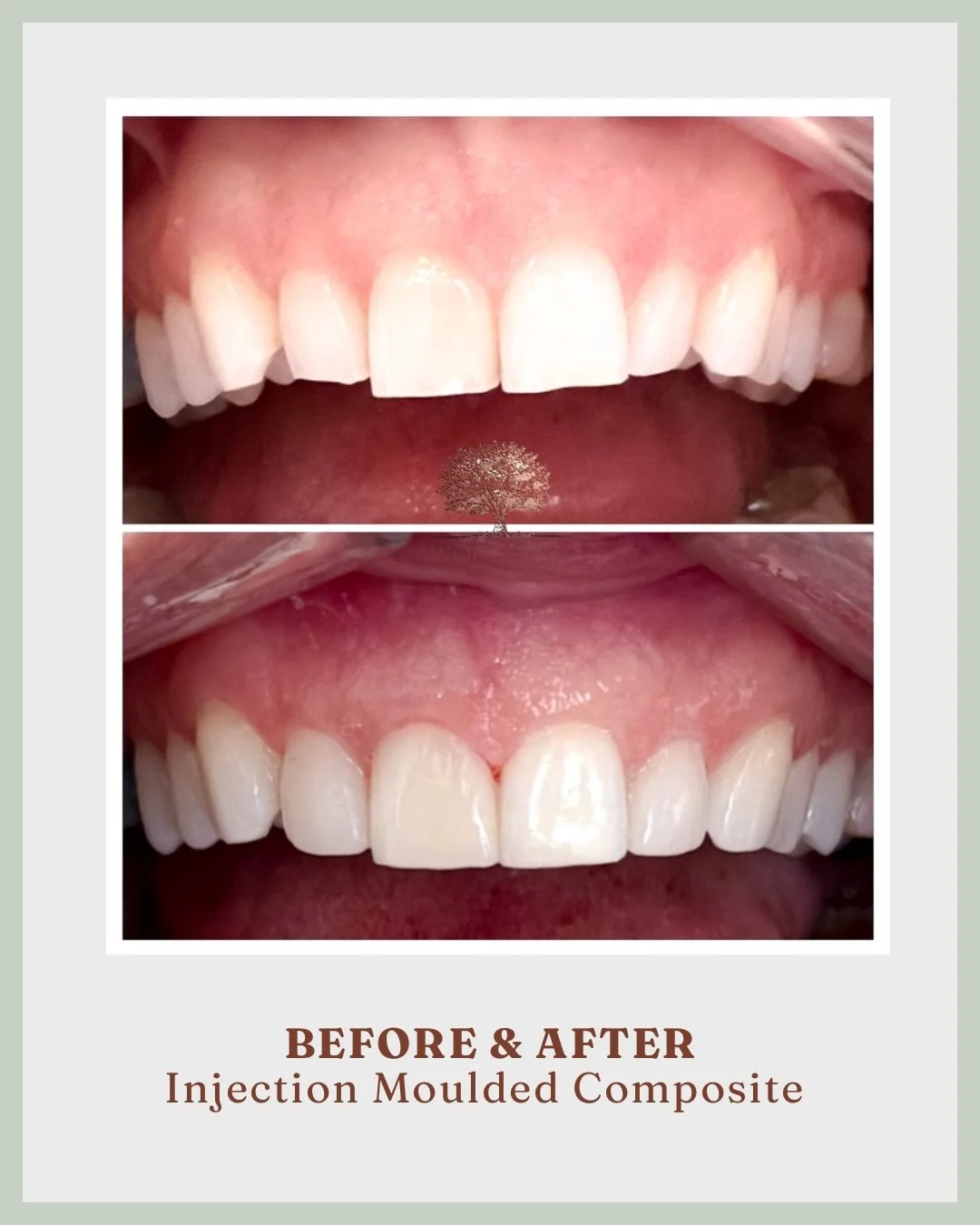 A beautifully natural smile transformation 🤍

This result was achieved using advanced injection moulded composite - a highly precise, minimally invasive technique that allows us to enhance shape, repair wear, and improve symmetry with exceptional ac