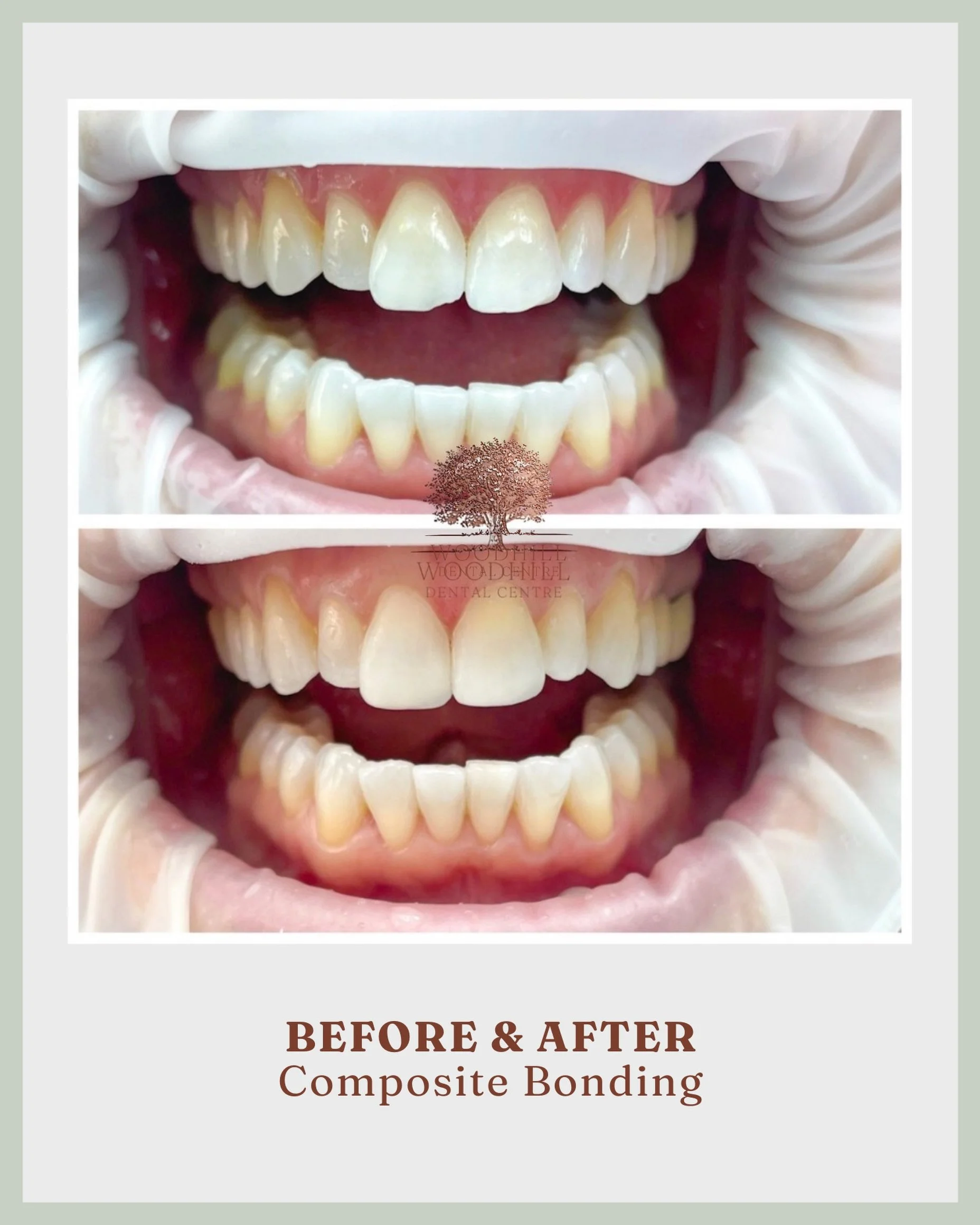 Completed in just one appointment, this composite bonding treatment focused on evening out the worn edges on our patient&rsquo;s upper central teeth.

By treating just two teeth, we achieved a fresh, natural looking result with a simple change that m