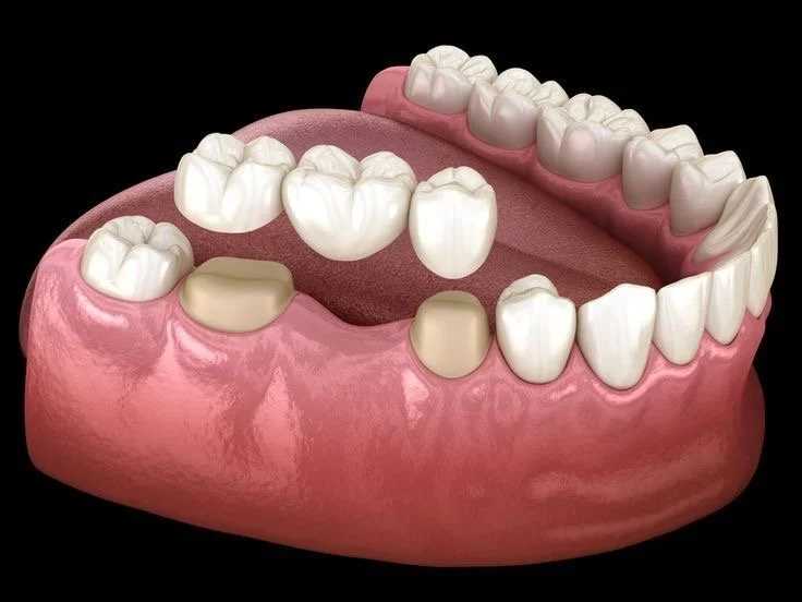 REHABILITACIÓN ORAL • PRÓTESIS