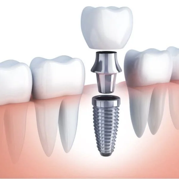 Implantes dentales