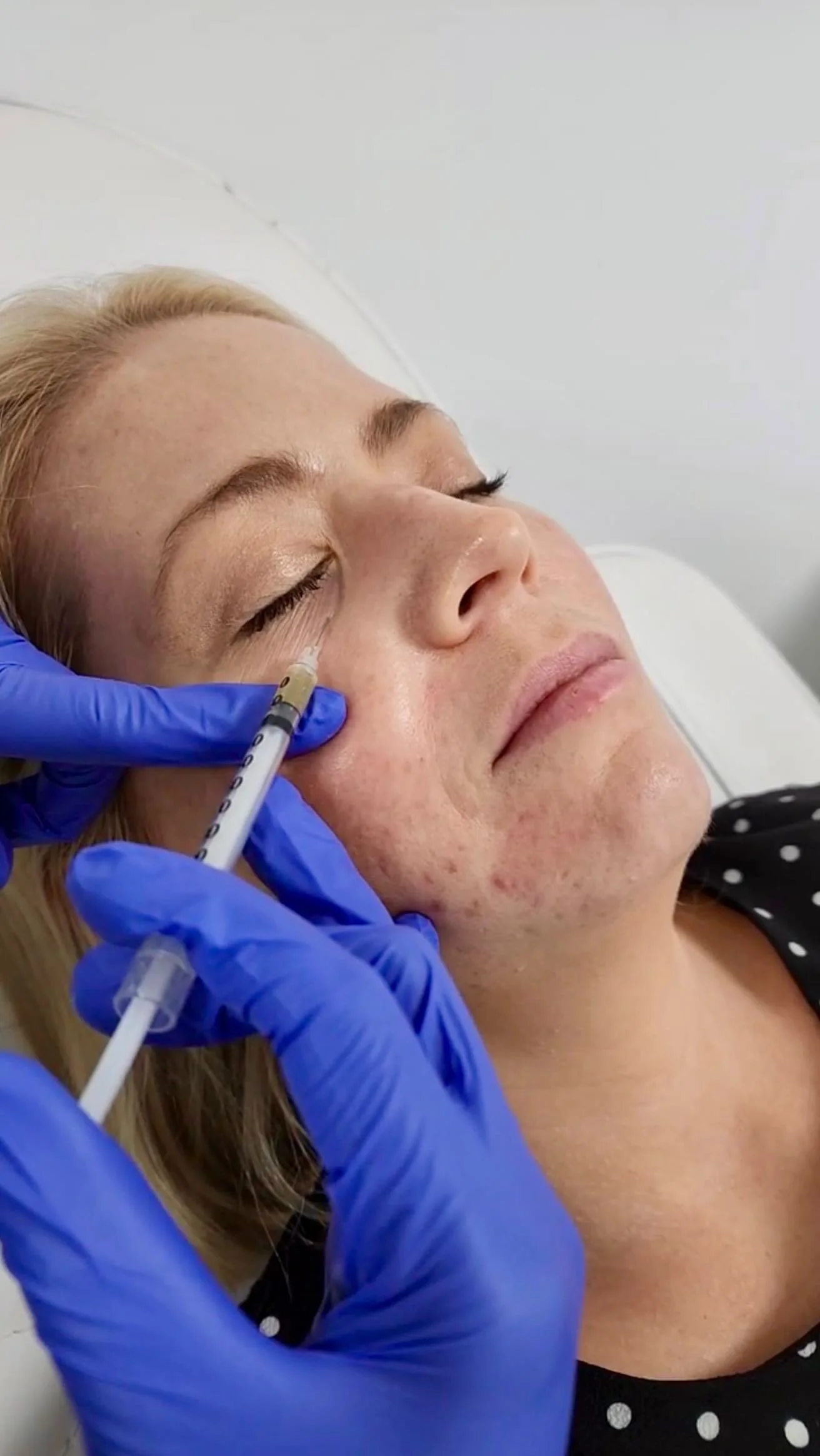 Are you considering PRP? When injected superficially into the skin, it initiates a stem cell response that will kickstart the body to form new collagen, elastin and blood vessels to repair and regenerate the skin.
Book your consultation today!
Dis
