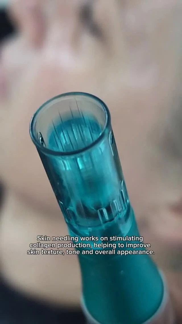 Have you considered incorporating skin needling into your treatment plan?
Skin needling, also known as microneedling, is a treatment that stimulates collagen production, helping to improve skin texture, tone and overall appearance.
Whether you&rsqu