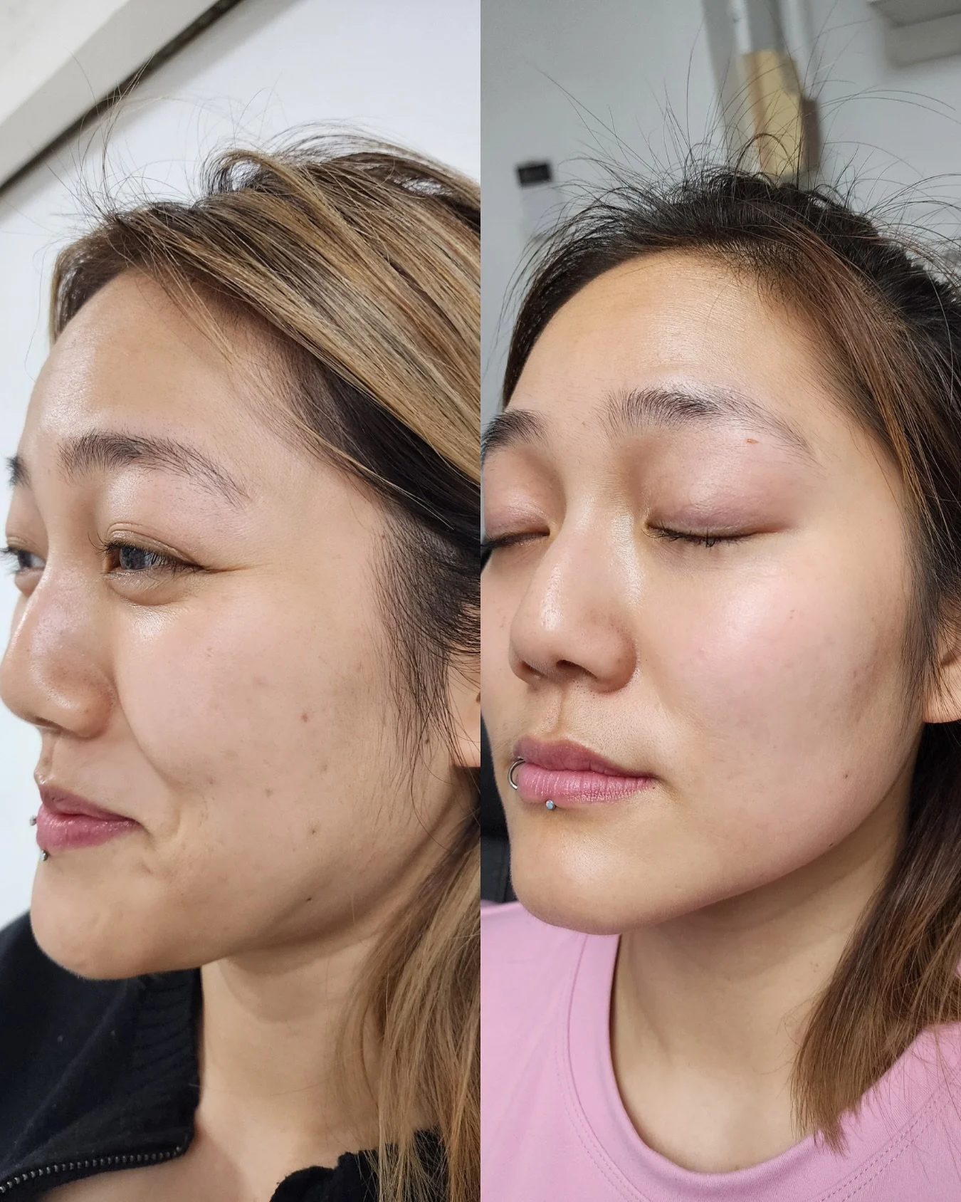 Want to know more?
This treatment works to treat hair loss, dark circles (particularly under eye), ache scarring, skin texture, tone & quality to stimulate collagen, stretch marks, restore moisture and glow.
Interested to know more about PRP?