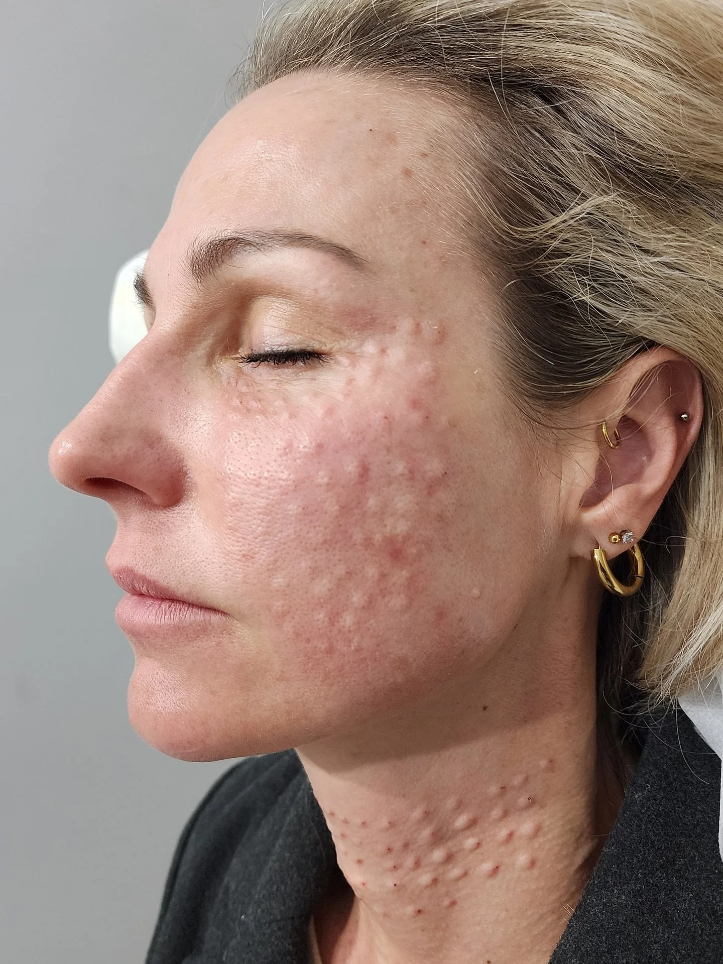 Are you interested to know more about Rejuran?
Rejuran is an advanced skin rejuvenation treatment that uses polynucleotides to stimulate collagen production, enhance skin elasticity, and improve overall texture. This innovative treatment helps to re
