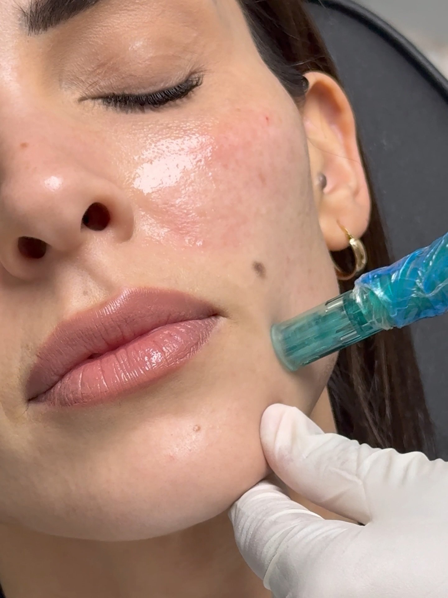 Disclaimer: Any surgical or invasive procedure Carries risks. Before proceeding you are urged to seek a second opinion from a qualified health practitioner. All results vary for each individual patient this includes: recovery and potential complicati