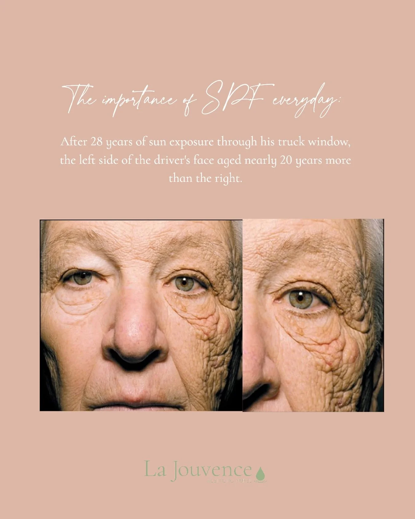 Just a little reminder why your SPF is so important for your overall skin health! 

Disclaimer: Any surgical or invasive procedure Carries risks. Before proceeding you are urged to seek a second opinion from a qualified health practitioner. All resul