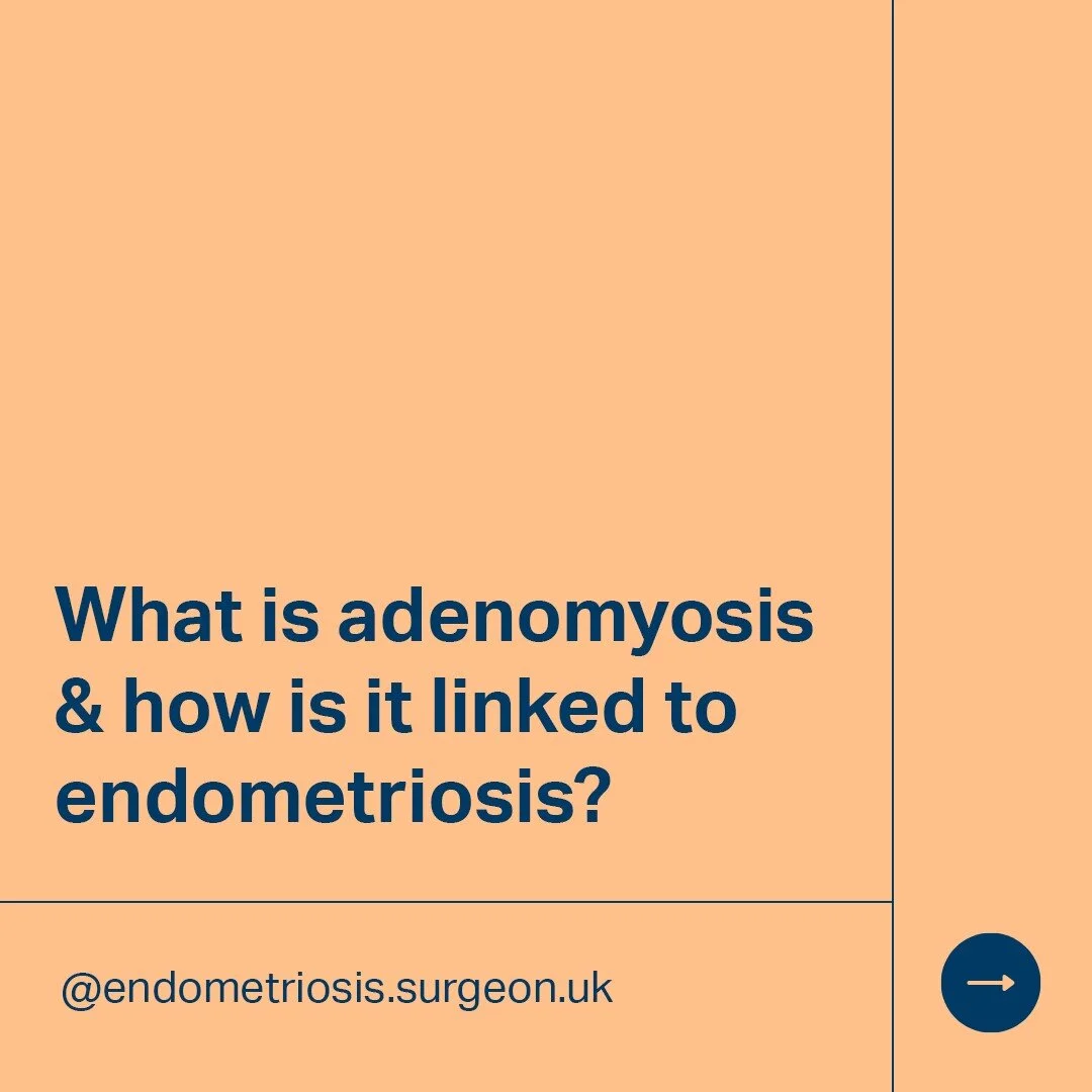 Adenomyosis and endometriosis can occur at the same time, although what causes this to happen remains unclear. Both conditions develop in a similar way, meaning it's likely that what has caused one condition is also causing the other condition to occ