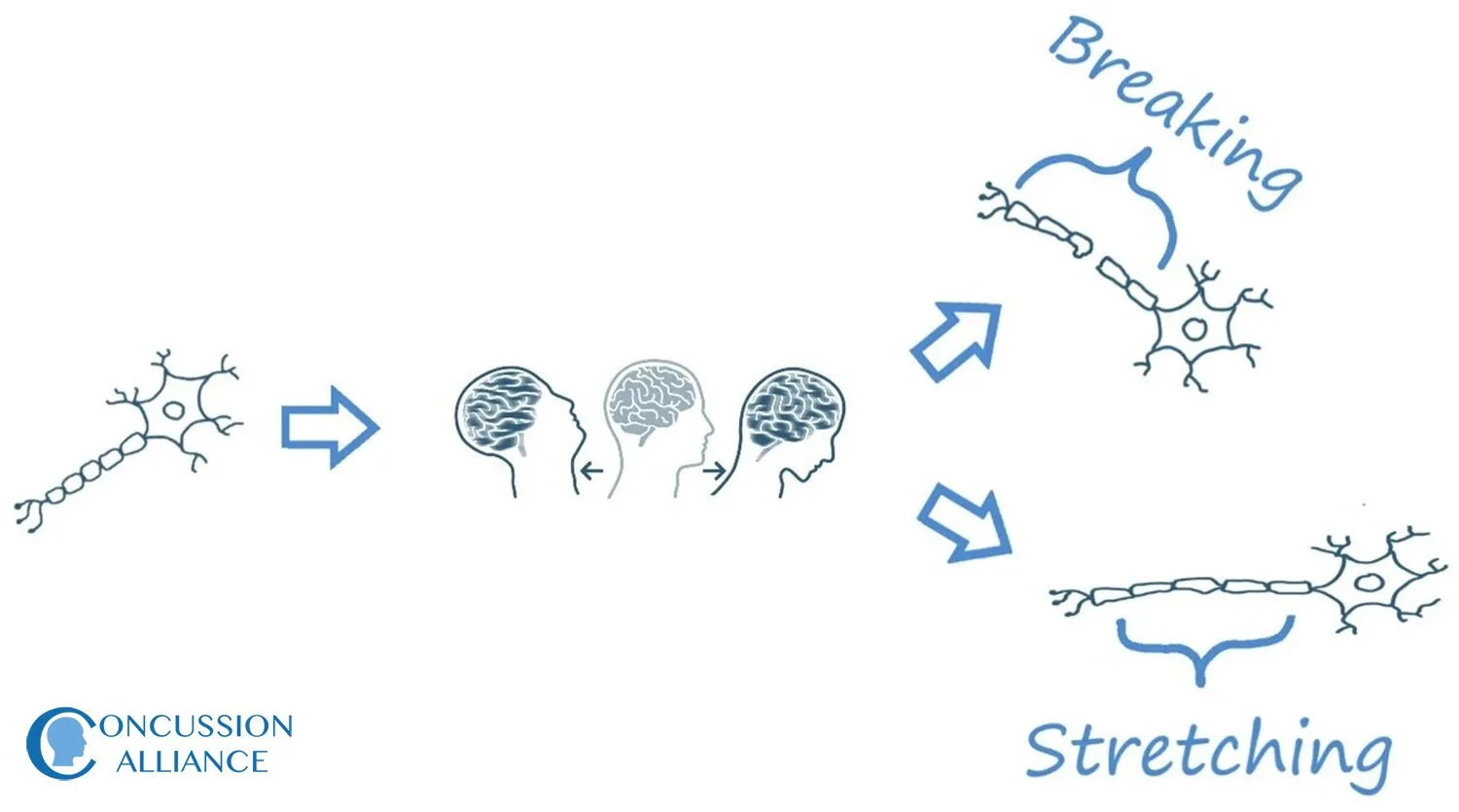 Brain deformation and damaged axons