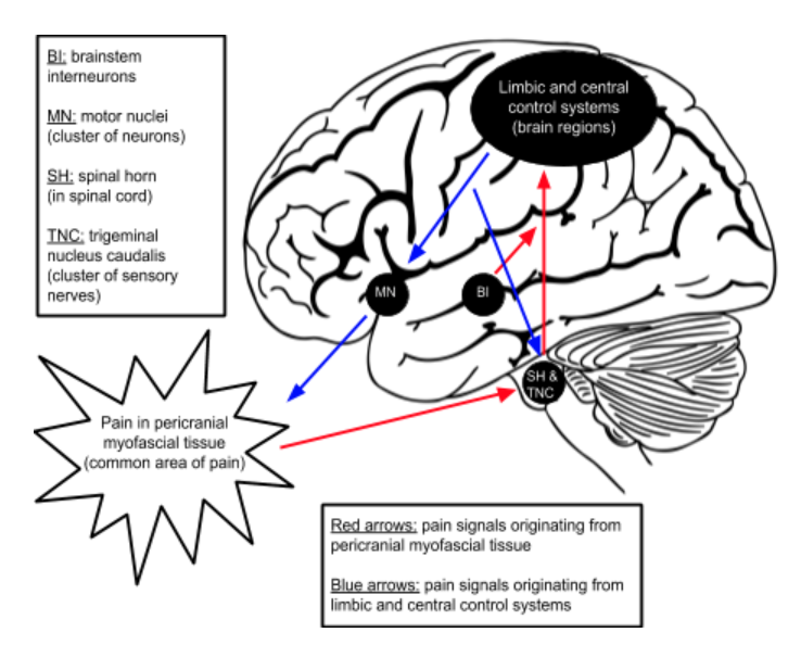 Headaches: Advanced Page — Concussion Alliance