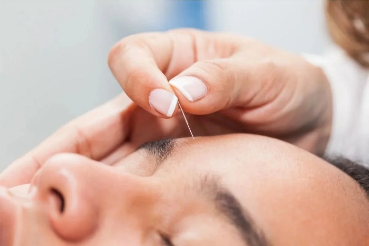 Acupuncture after concussion reduces symptoms and improves white matter integrity