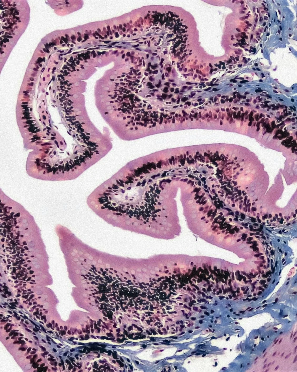 Recently Tested Positive for SIBO (or Suspect you Have it)? Here’s What Else you Need to Consider Beyond Treatment (so you Don’t End up with it Again)