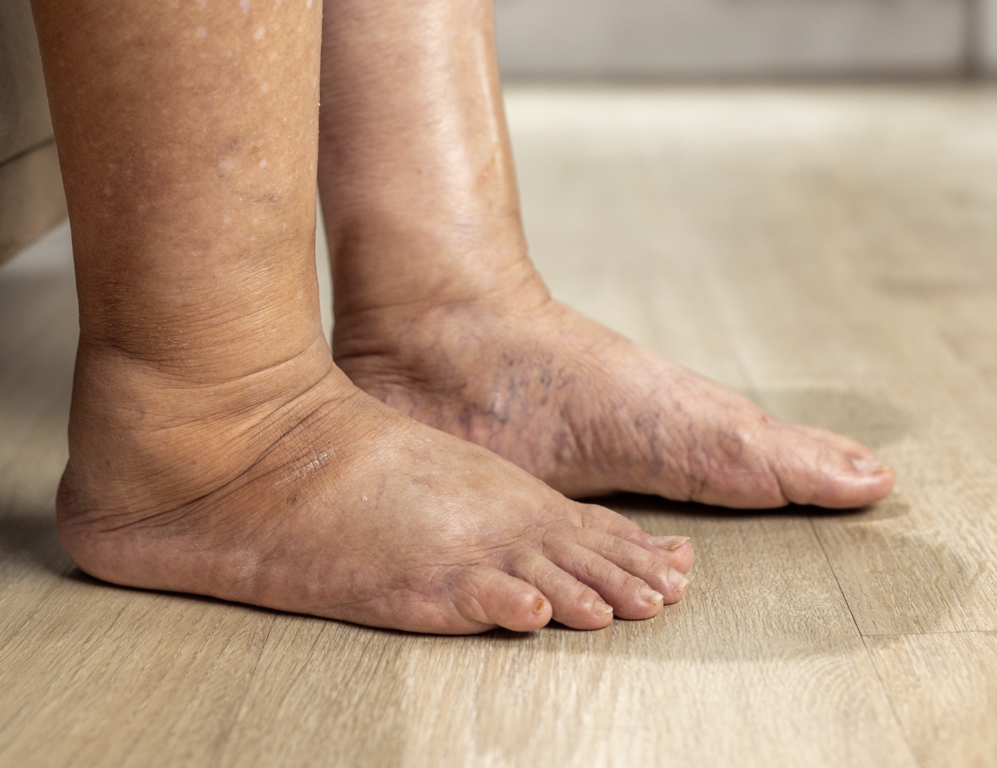 Lymphedema Rehab Fernie BC Physio