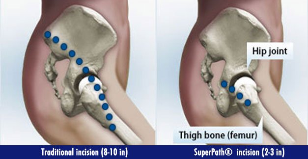 SuperPath Hip Replacement